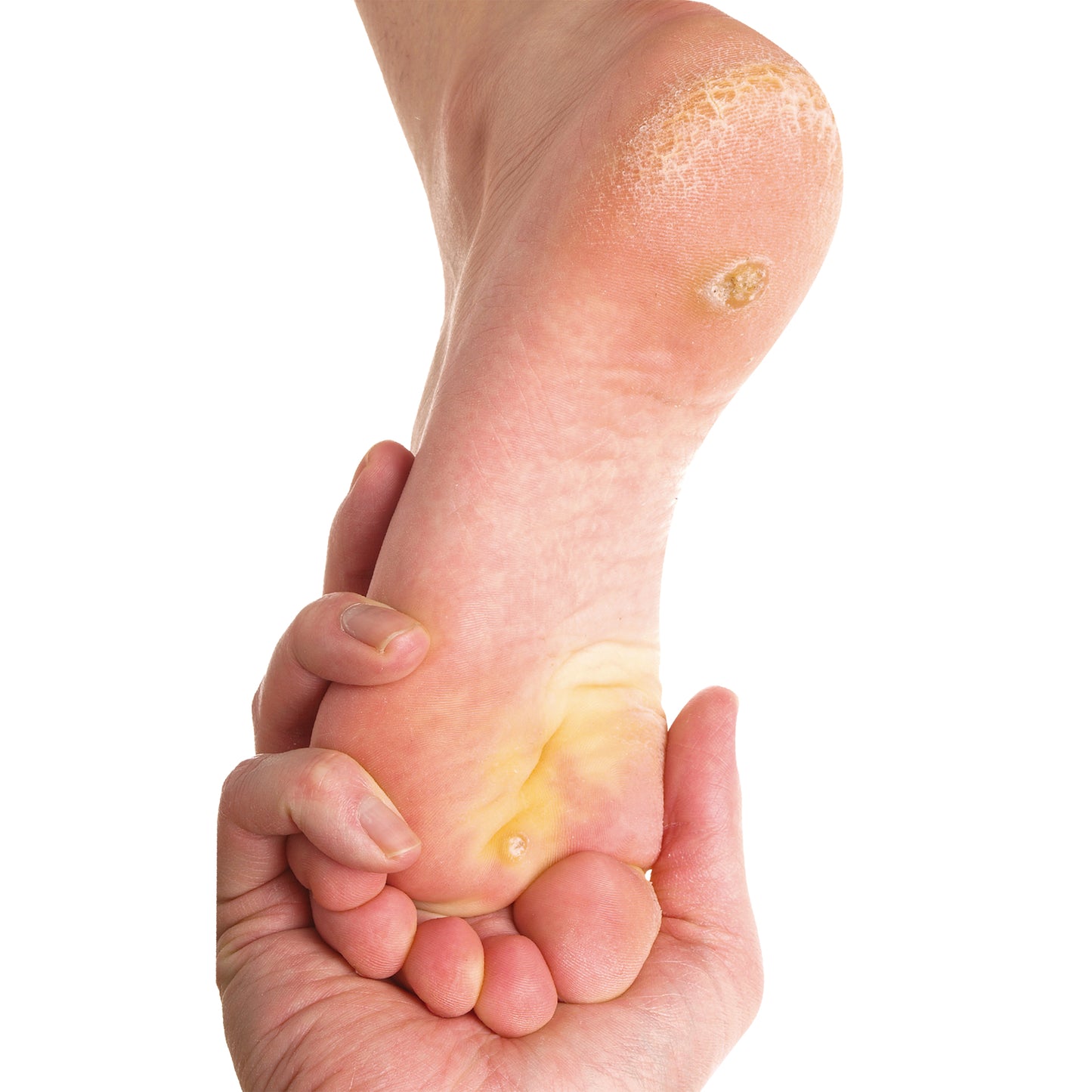 Callus Remover 150 ML | Crema ablandadora de callos